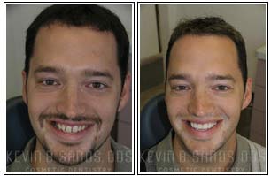Smile Makeover Before and After Gallery 01