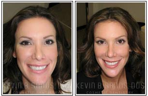Smile Makeover Before and After Gallery 02