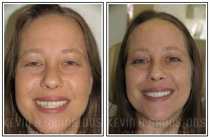 Smile Makeover Before and After Images