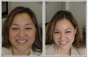 Smile Gallery Before and After 07